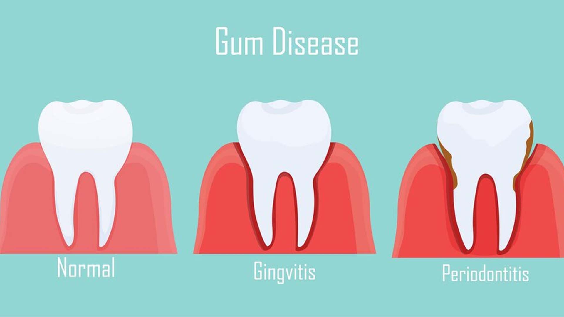Gum Disease