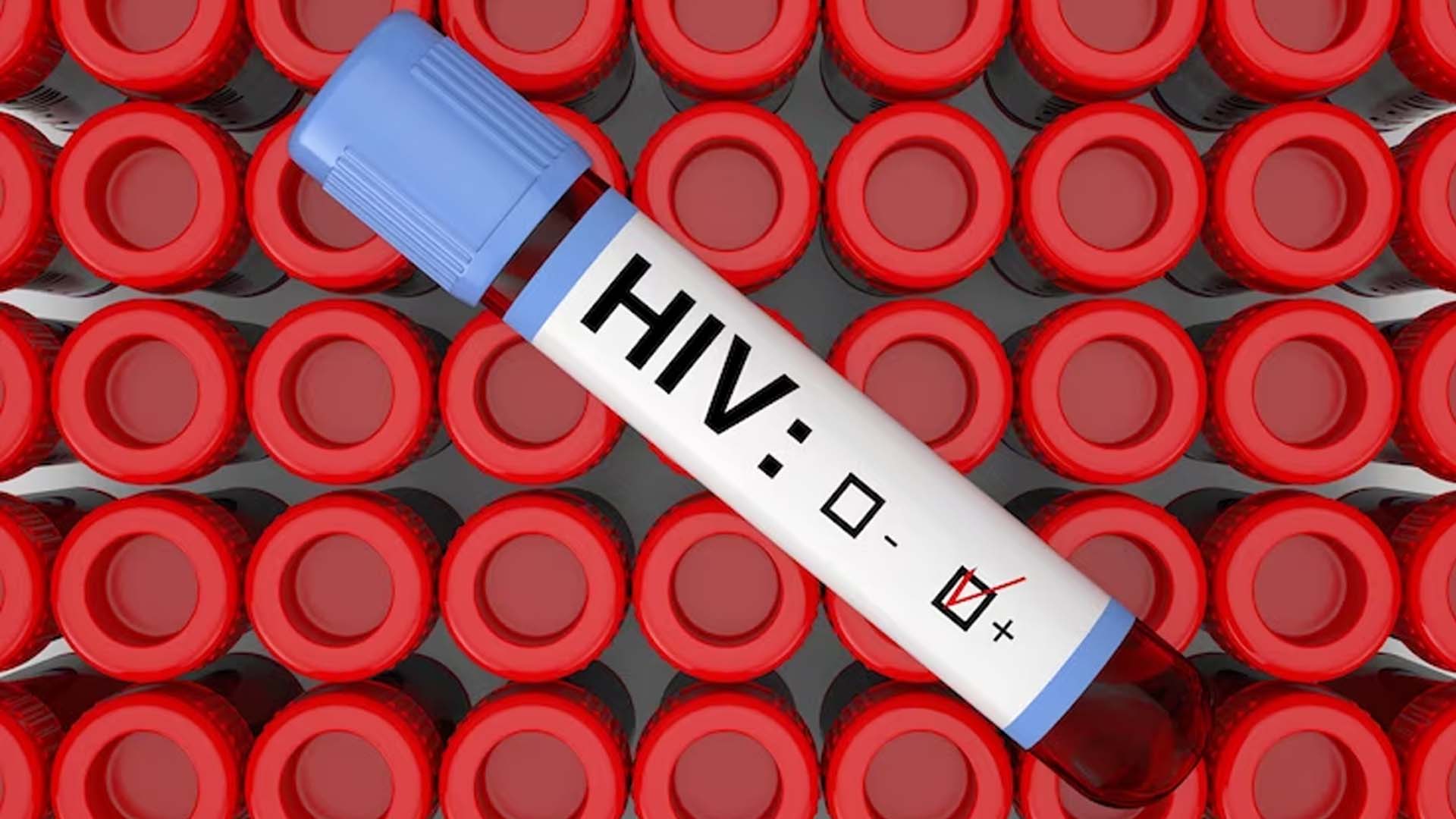 HIV (Human Immunodeficiency Virus) sample