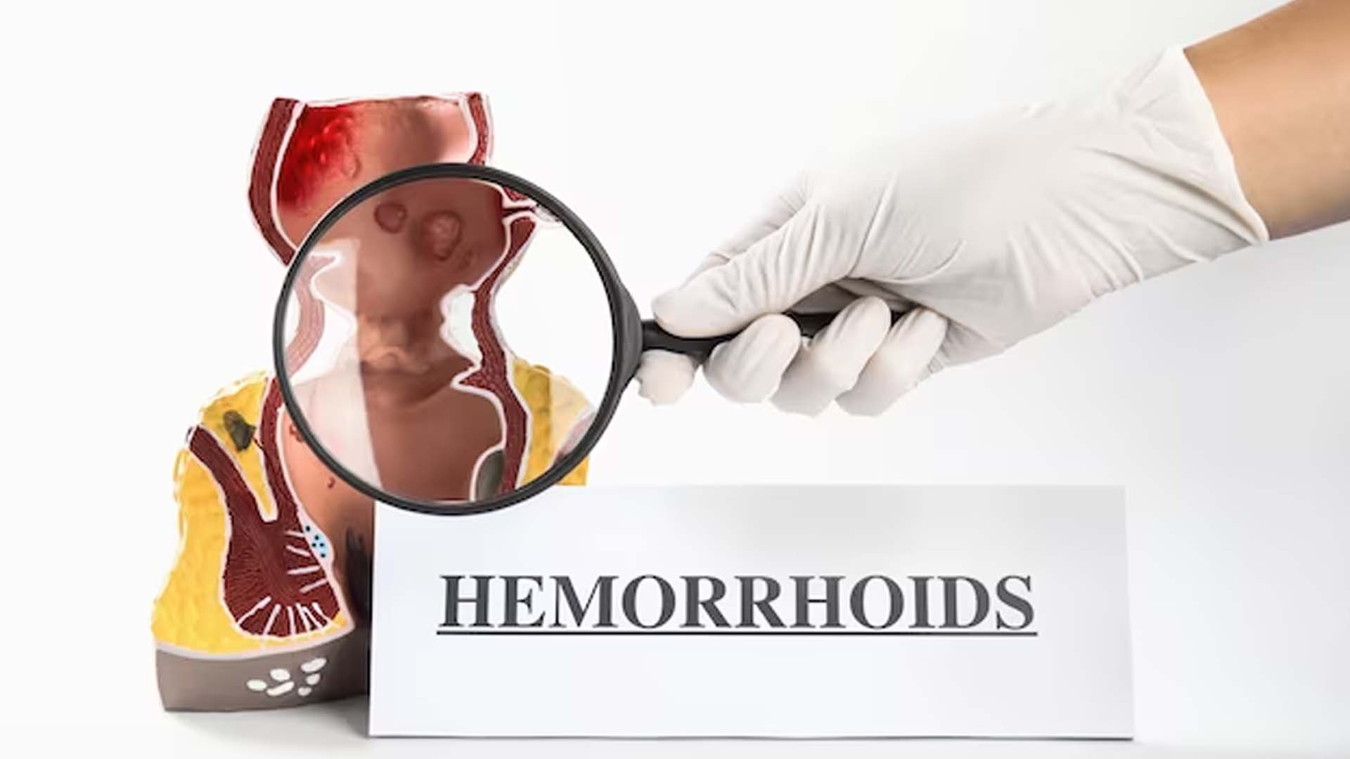 Hemorrhoids