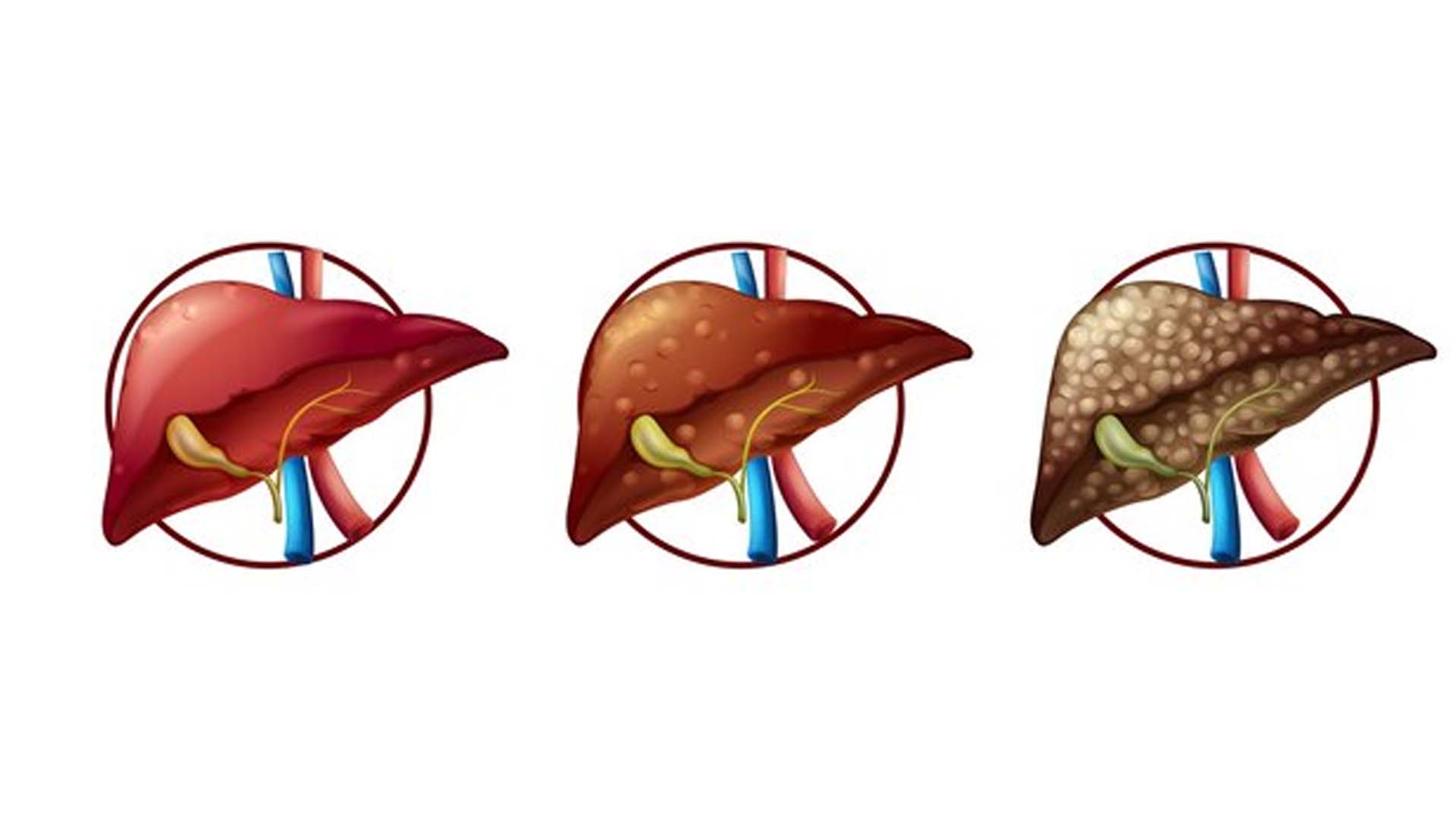 Liver problems