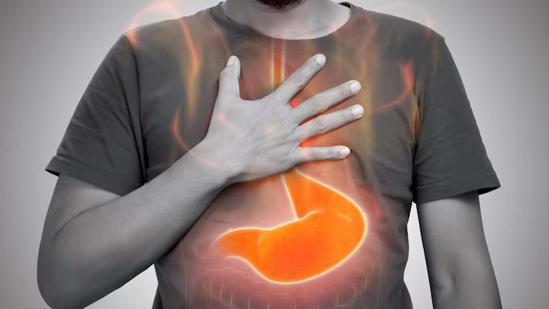 Acid reflux