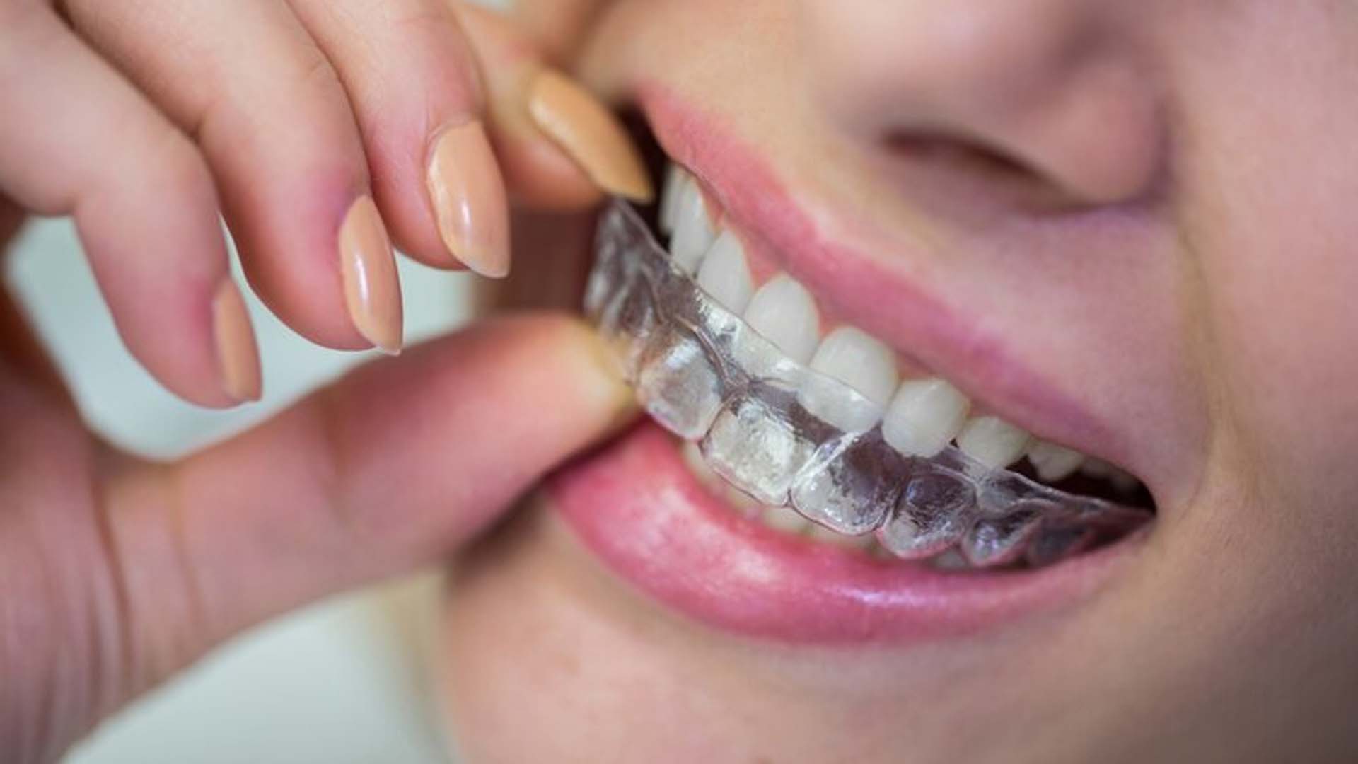 Retainers