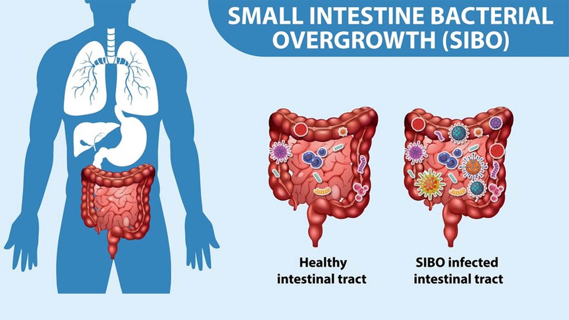 Small intestinal bacterial overgrowth (SIBO)