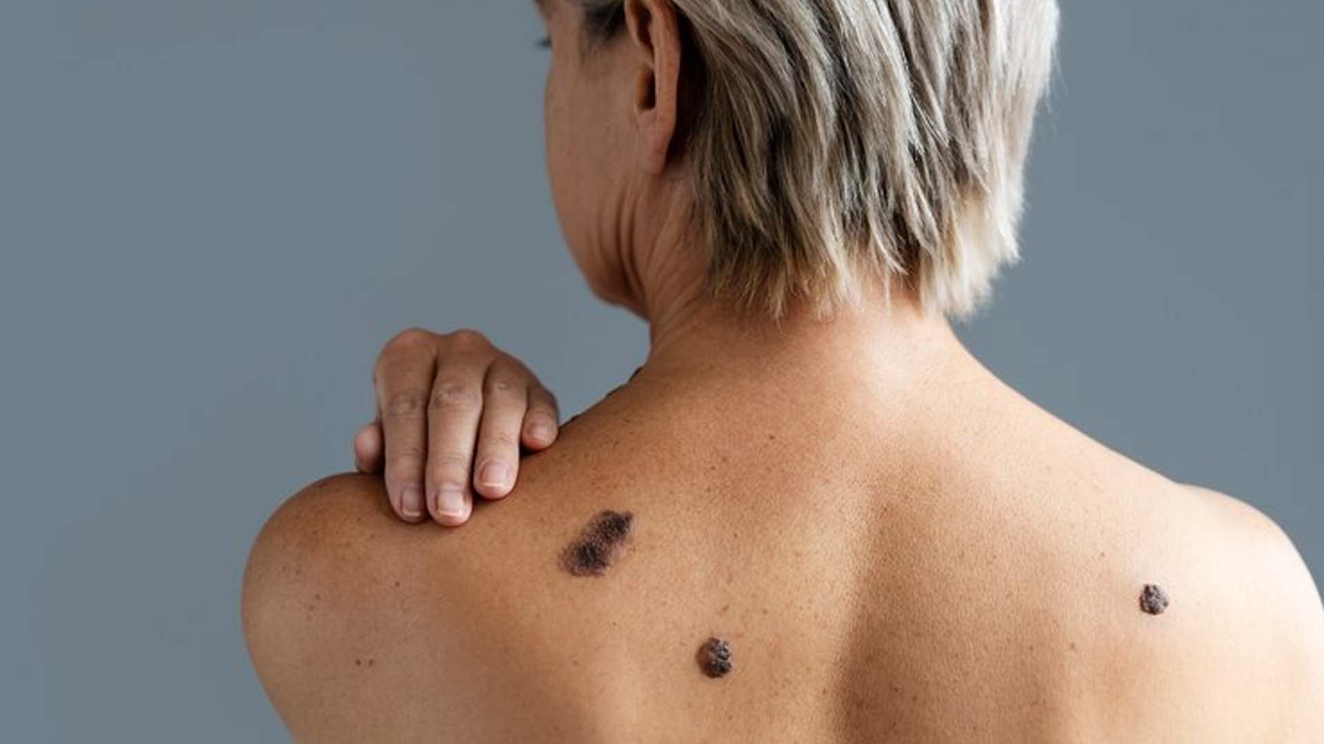 Skin Cancer