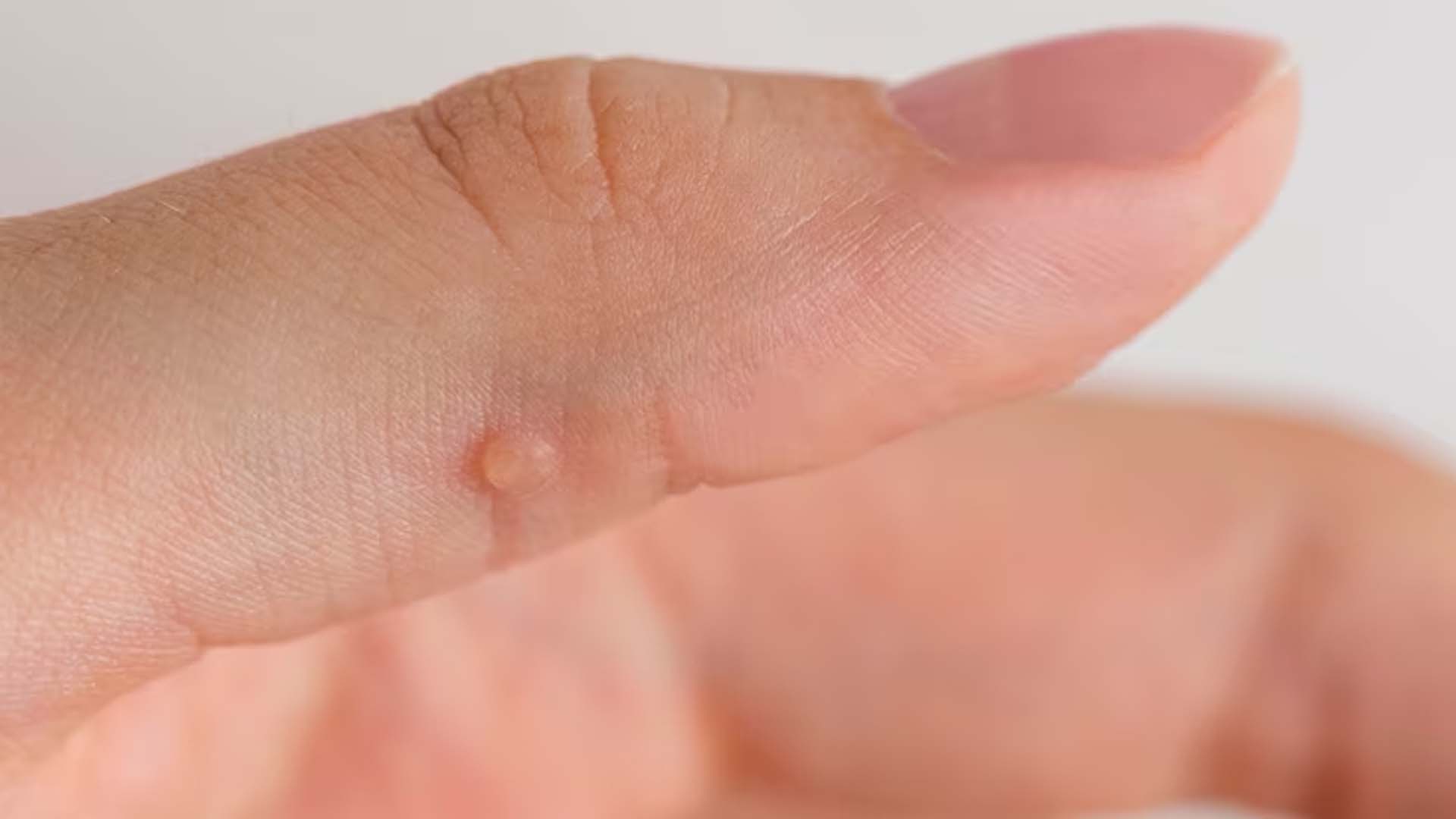 Wart on hand
