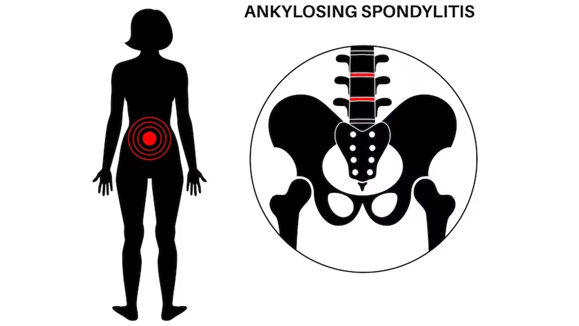 Ankylosing Spondylitis