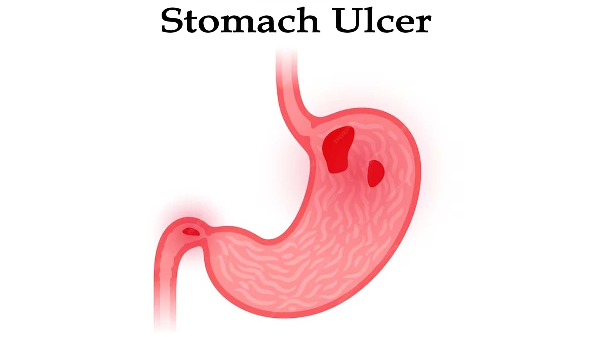 Stomach Ulcers