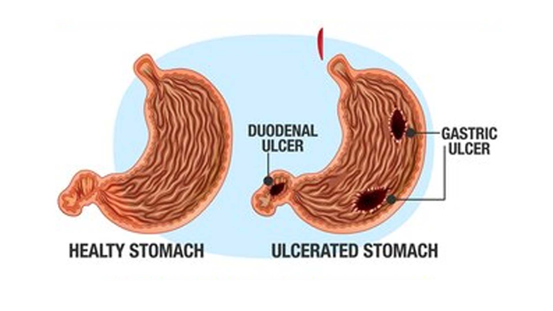 Stomach ulcers or peptic ulcers