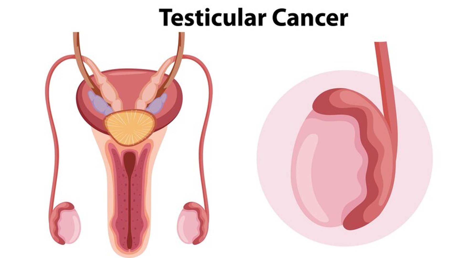Testicular Cancer