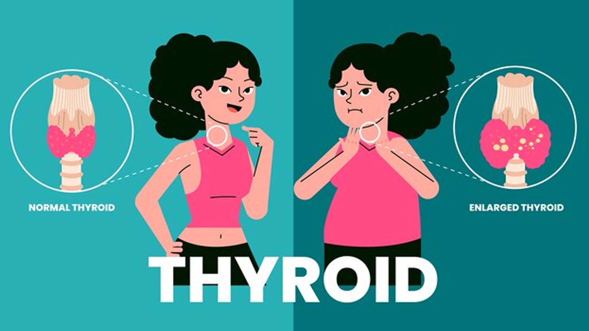 Thyroid