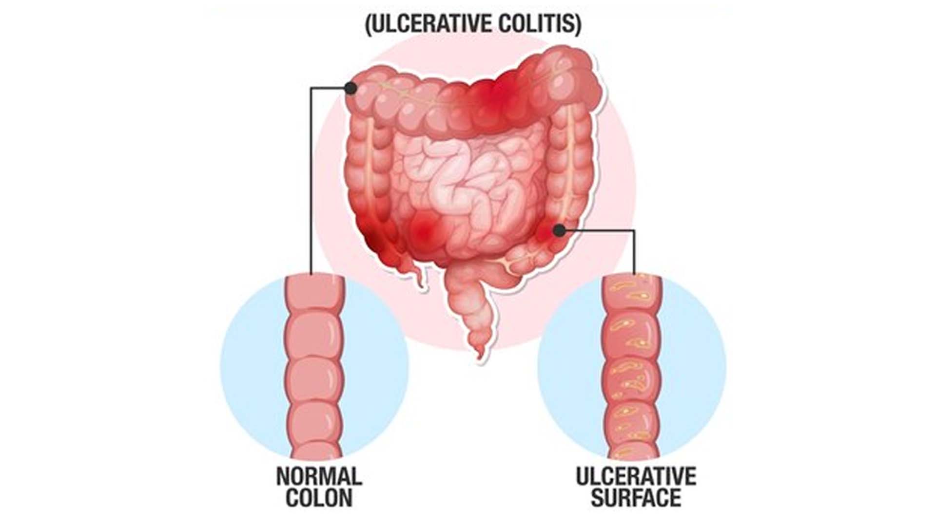 Ulcerative Colitis