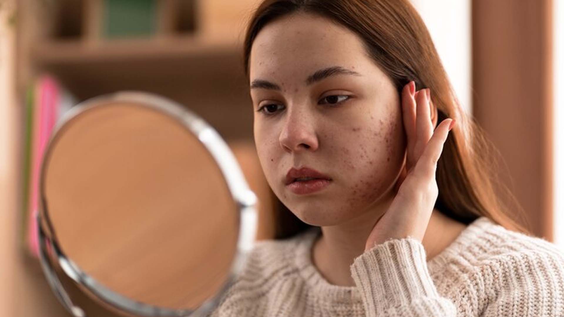 Rosacea