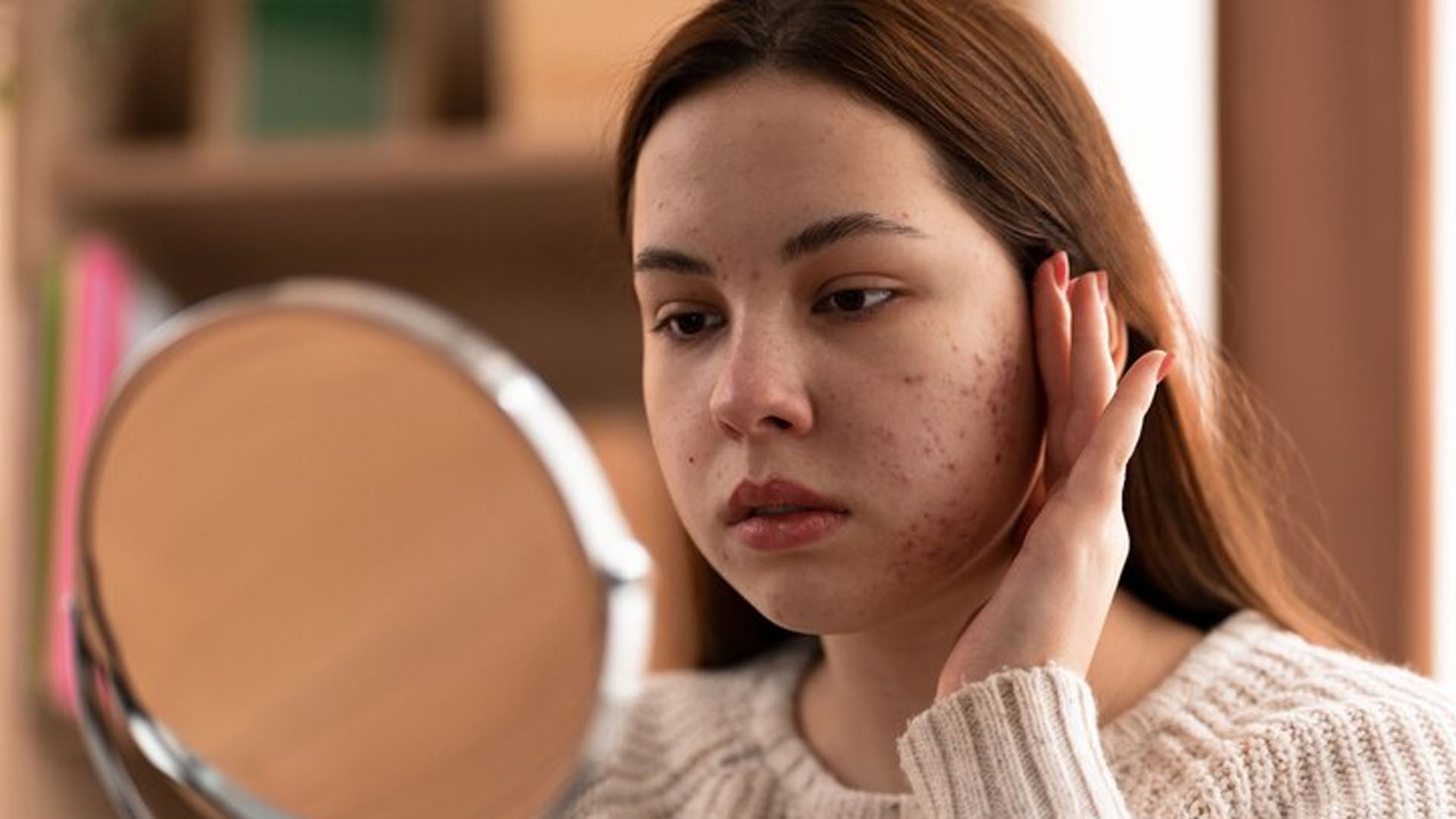 What are the Home Remedies for Acne Scars?