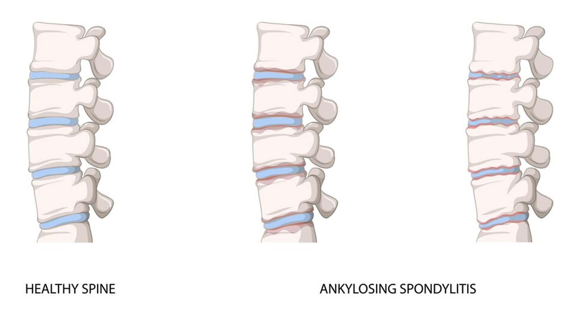 Ankylosing spondylitis (AS)