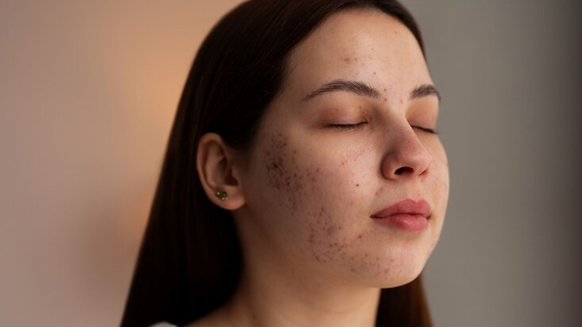 What are the Home Remedies to treat black spots on face?