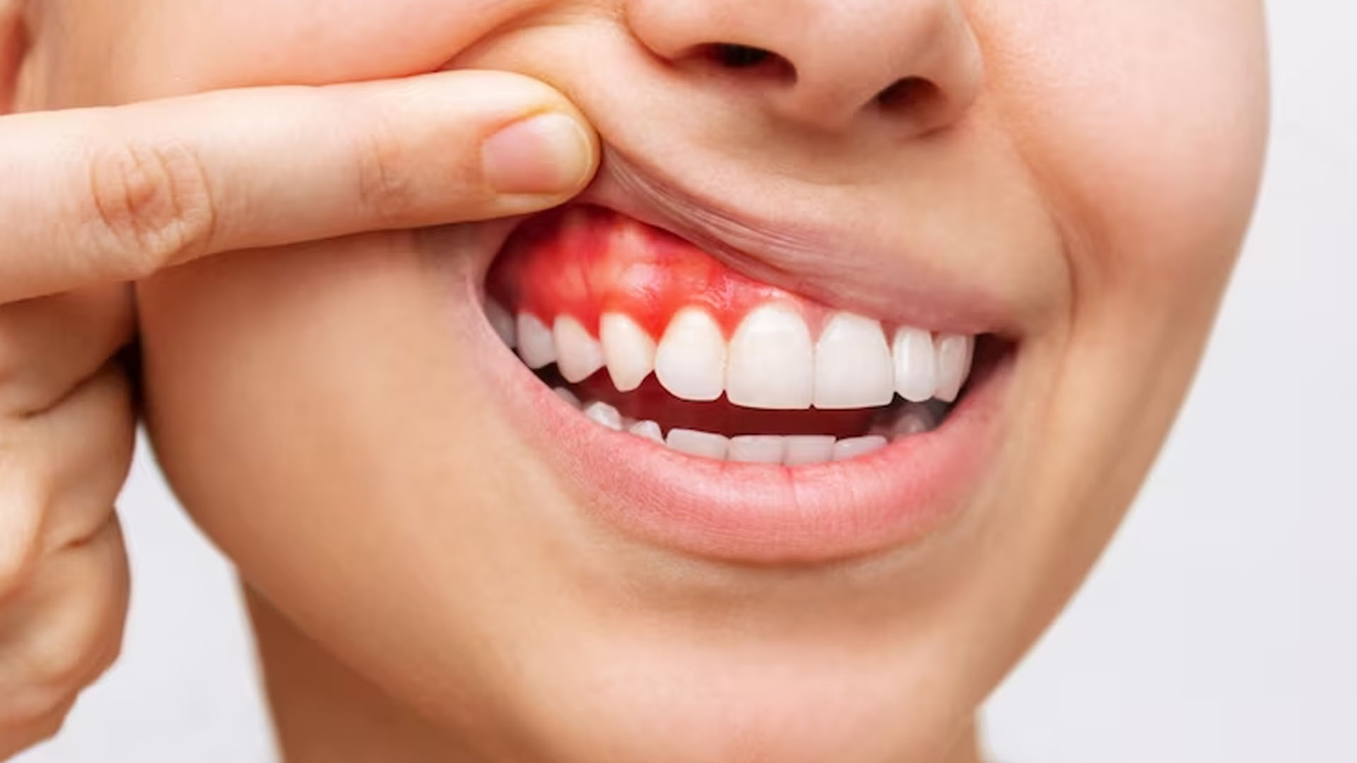 What are the Home Remedies for Bleeding Gums?