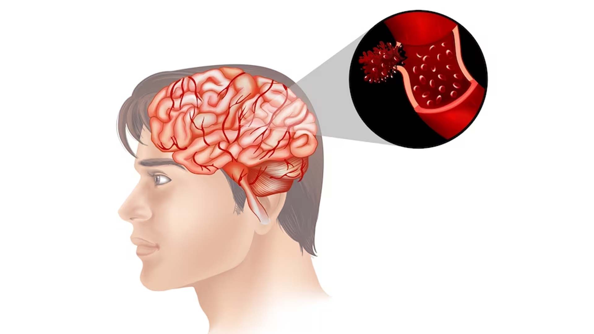 Brain Tumor