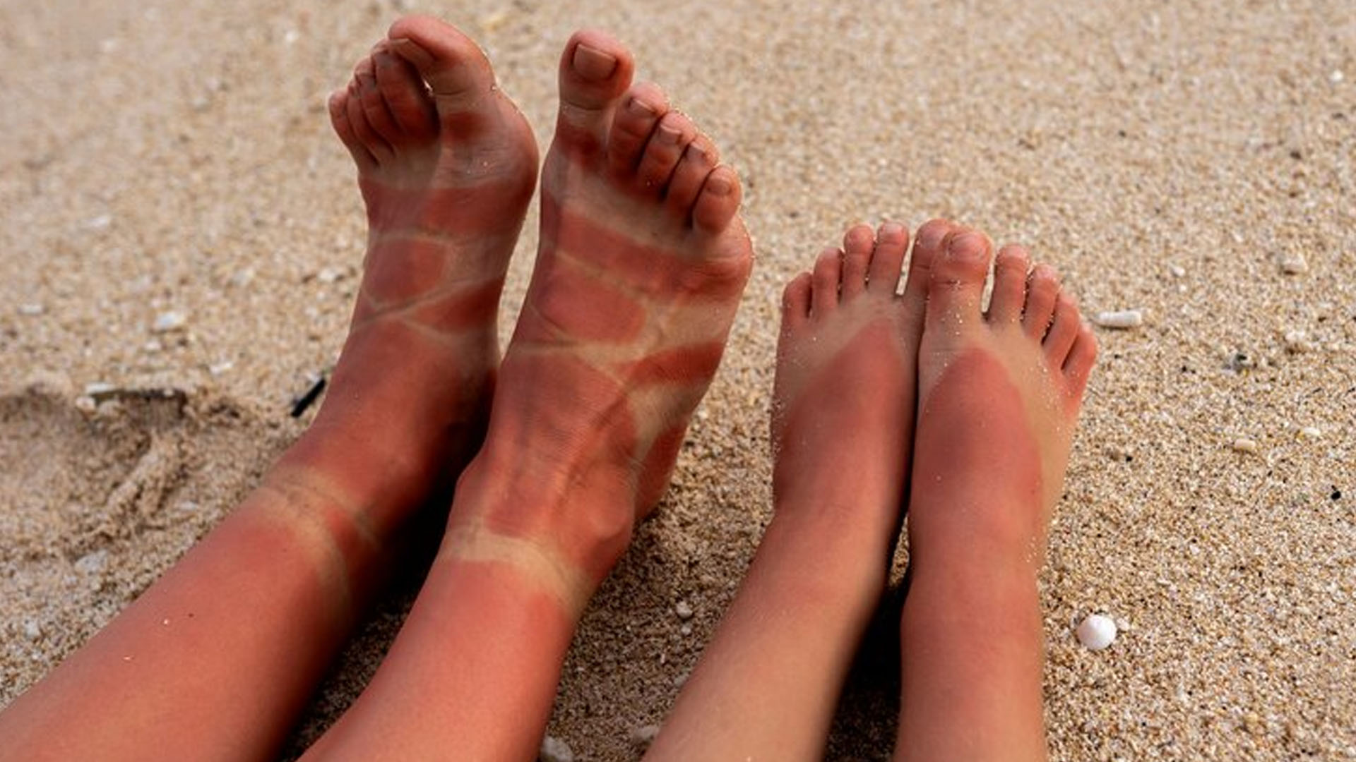 What are the Home Remedies for Burning Feet?