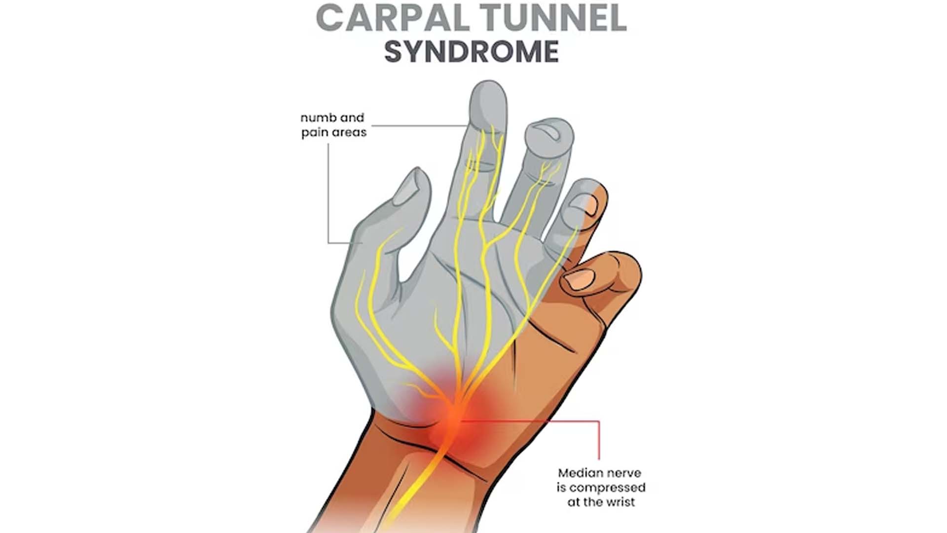 Carpal tunnel syndrome (CTS)