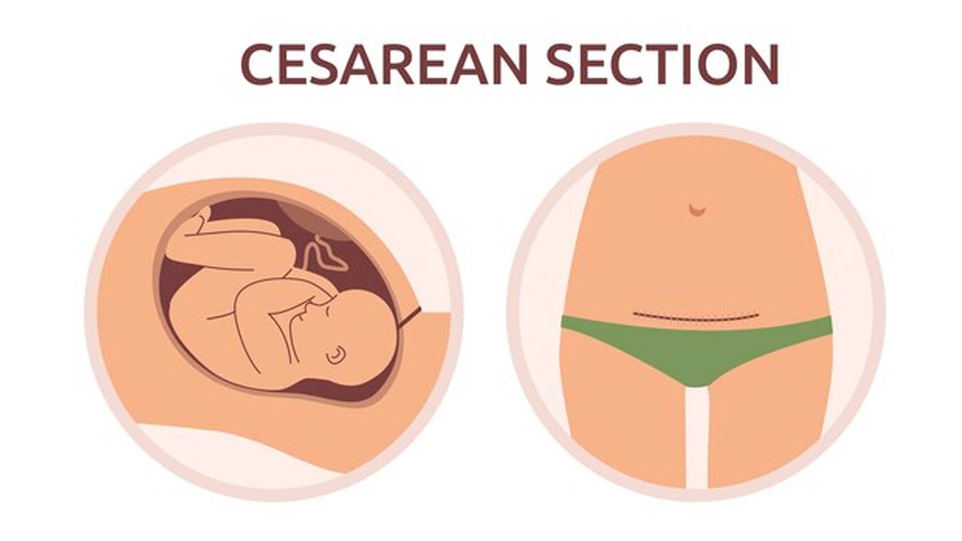 Cesarean section (C-section)