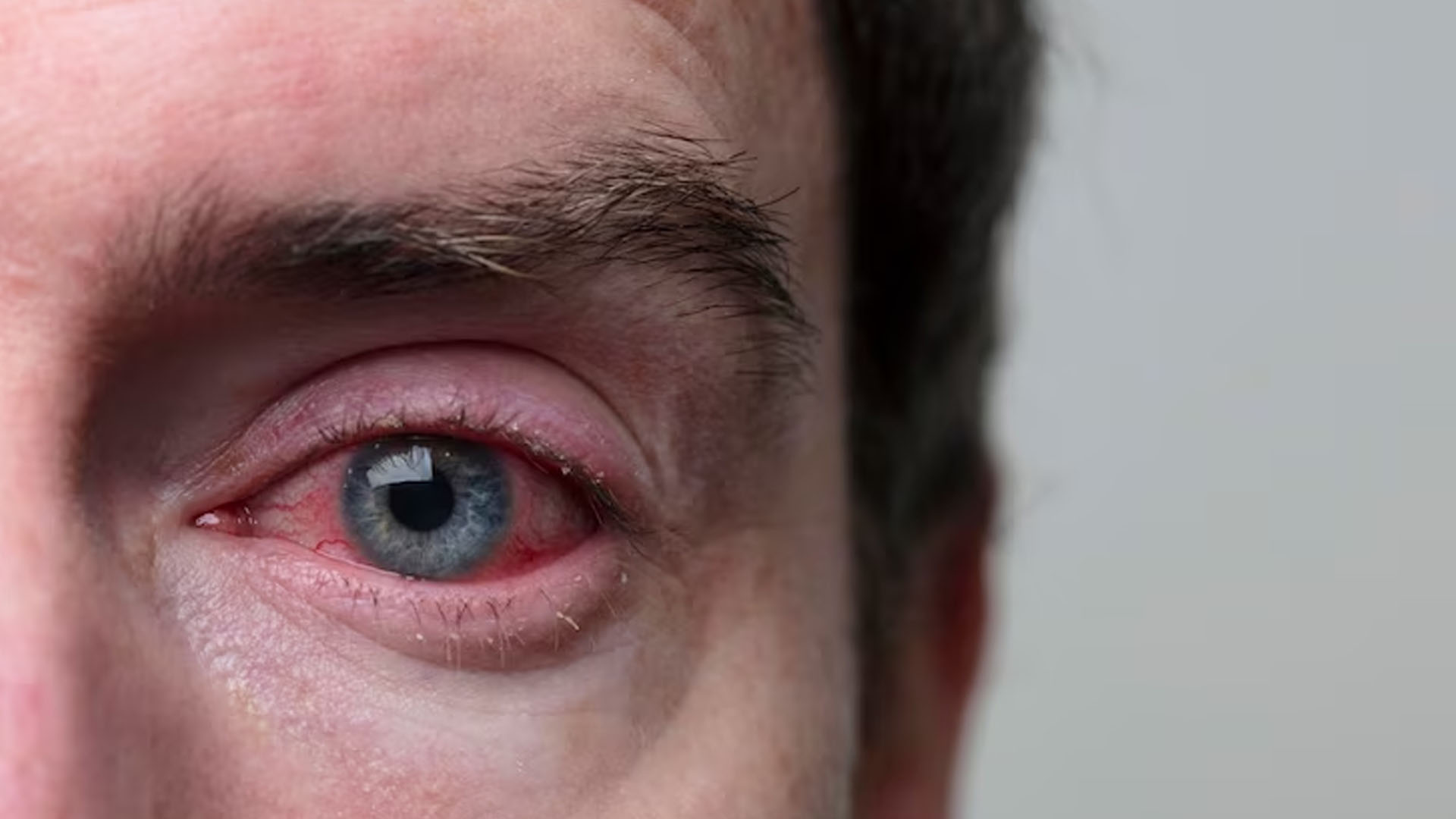 What are the Home Remedies for Conjunctivitis?v