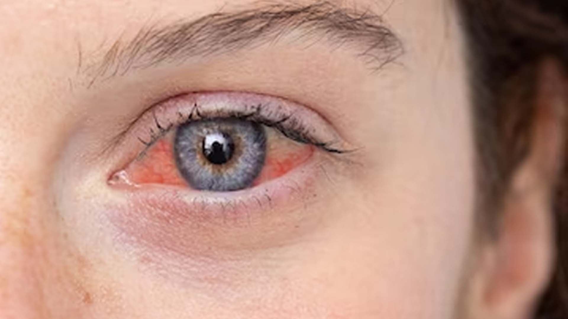Conjunctivitis