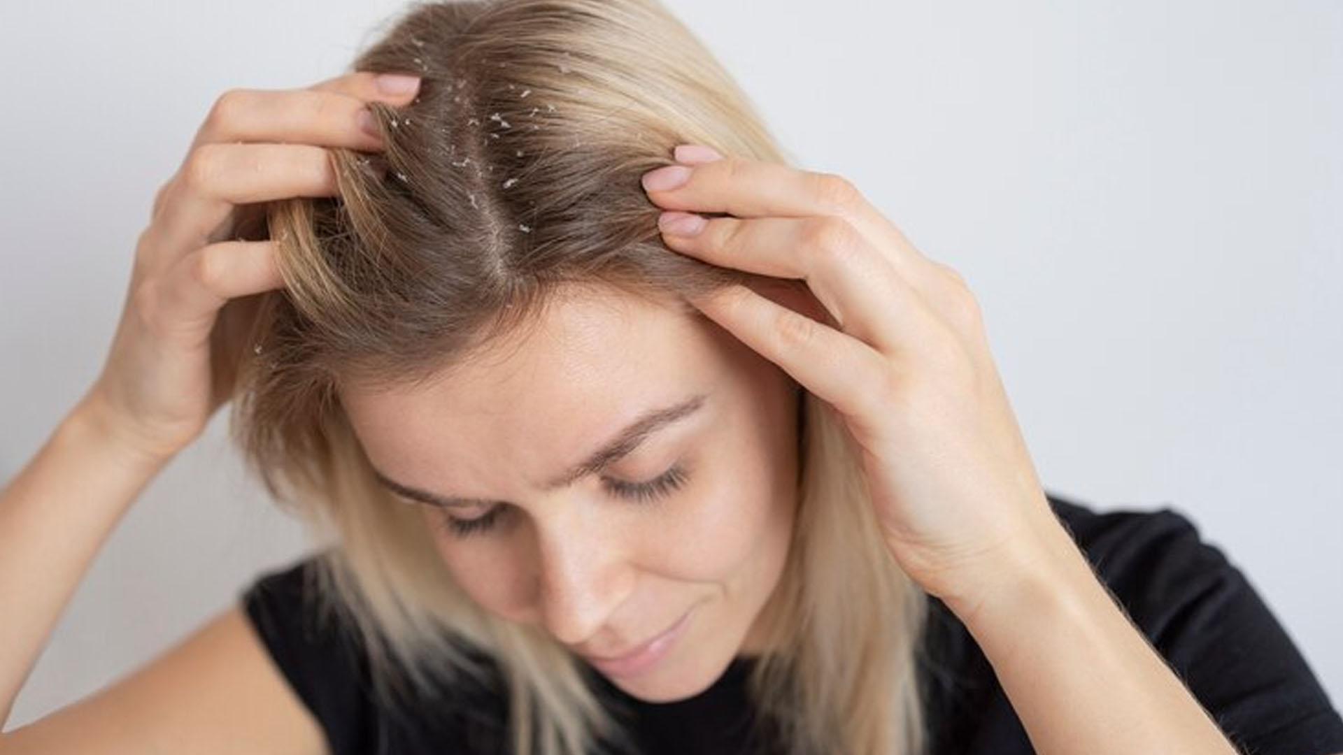 What are the Home Remedies for Dandruff?