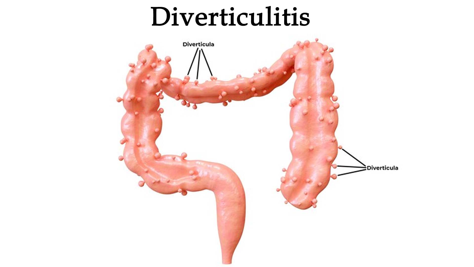 Diverticulitis