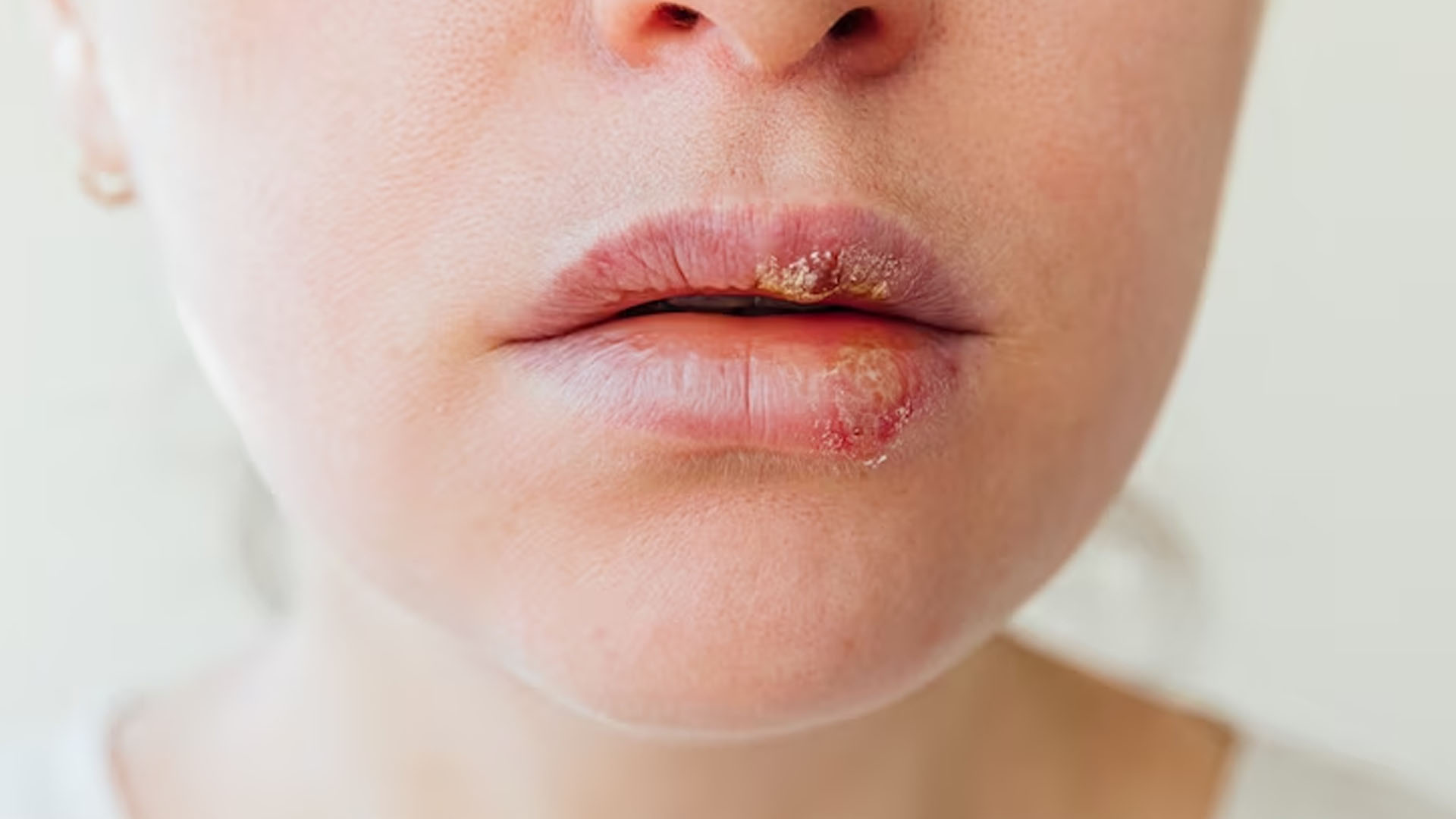 What are the Home Remedies for Dry Lips?