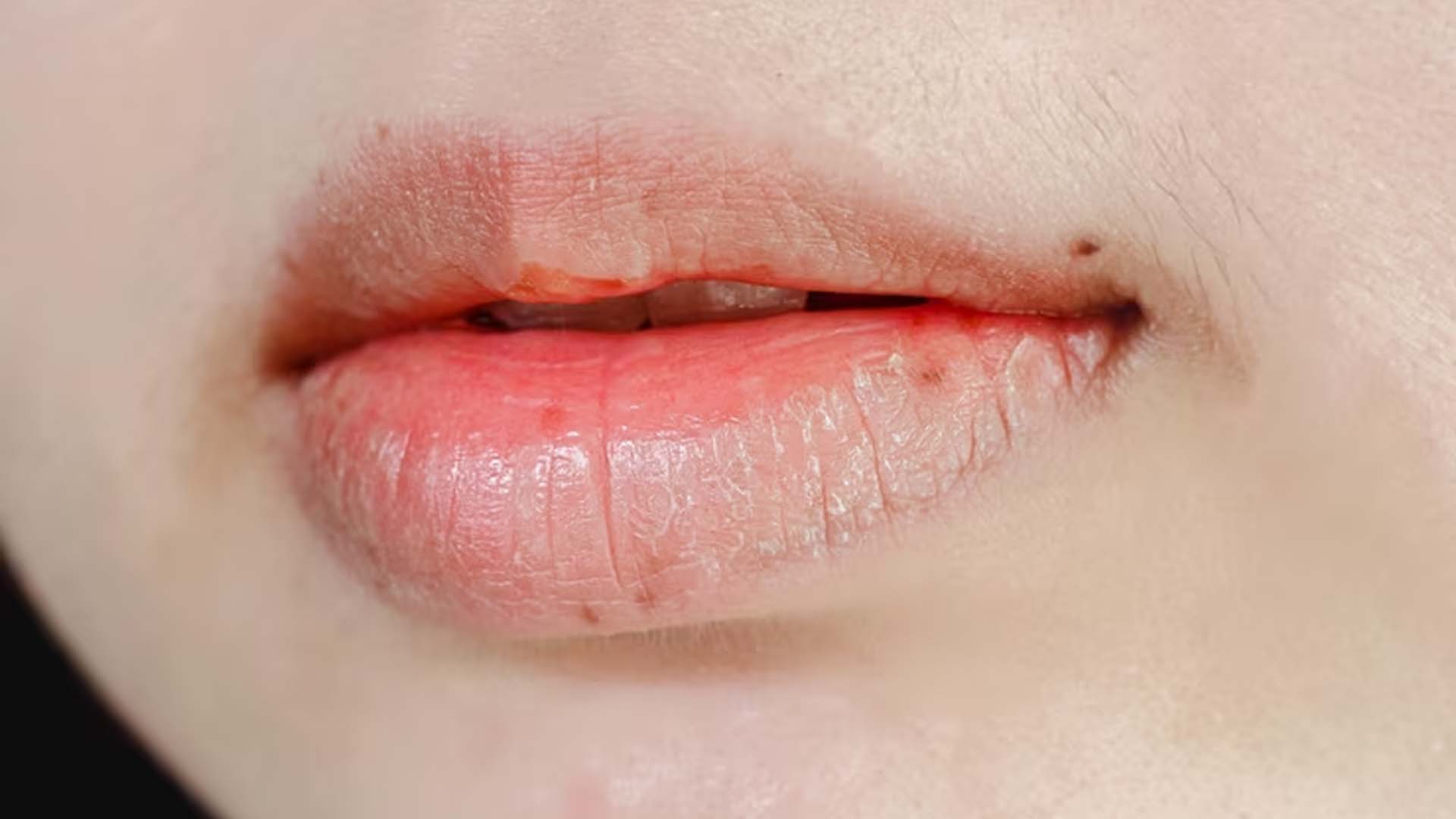 Dry Mouth