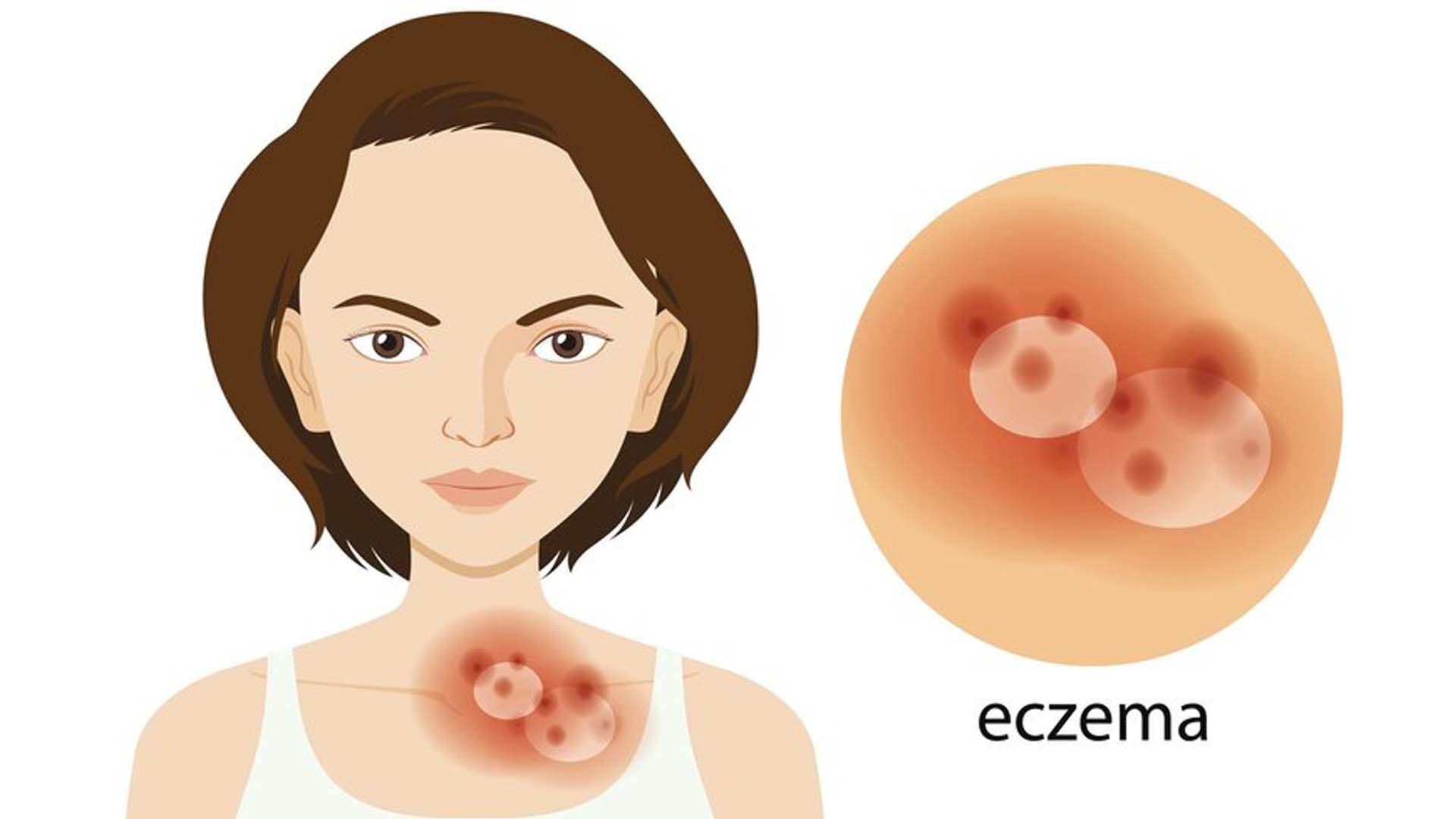Eczema