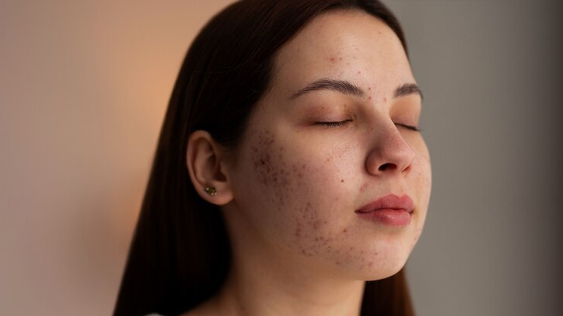 What are the Home Remedies for Face Pigmentation?