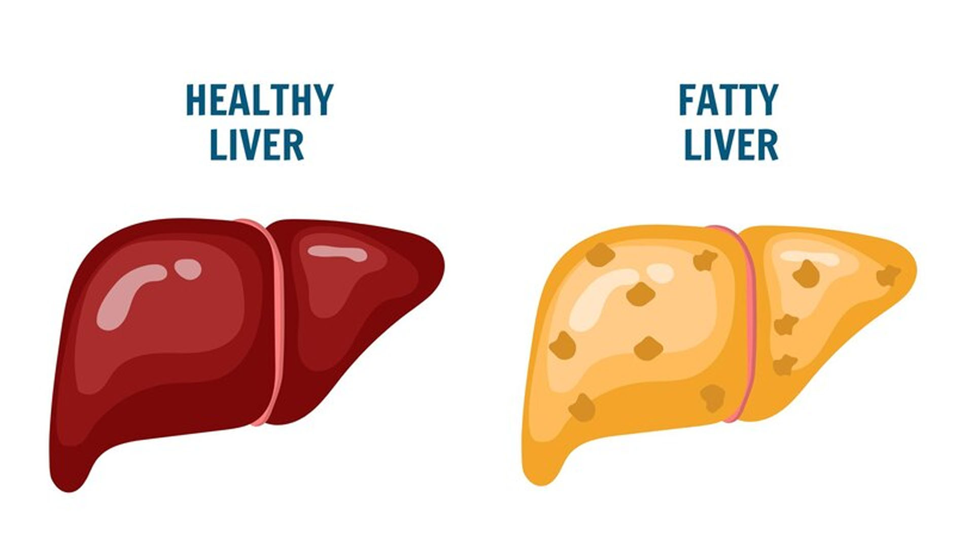What are the Home Remedies to treat Fatty Liver Disease?