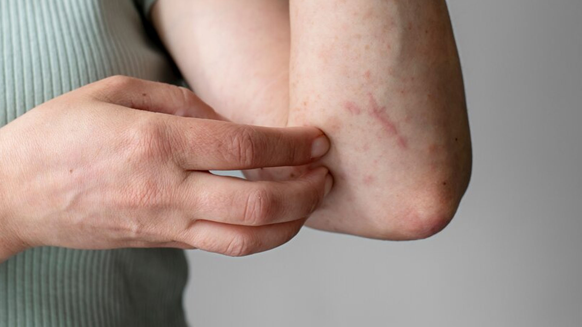What are the Home Remedies to Prevent Fungal Infections?