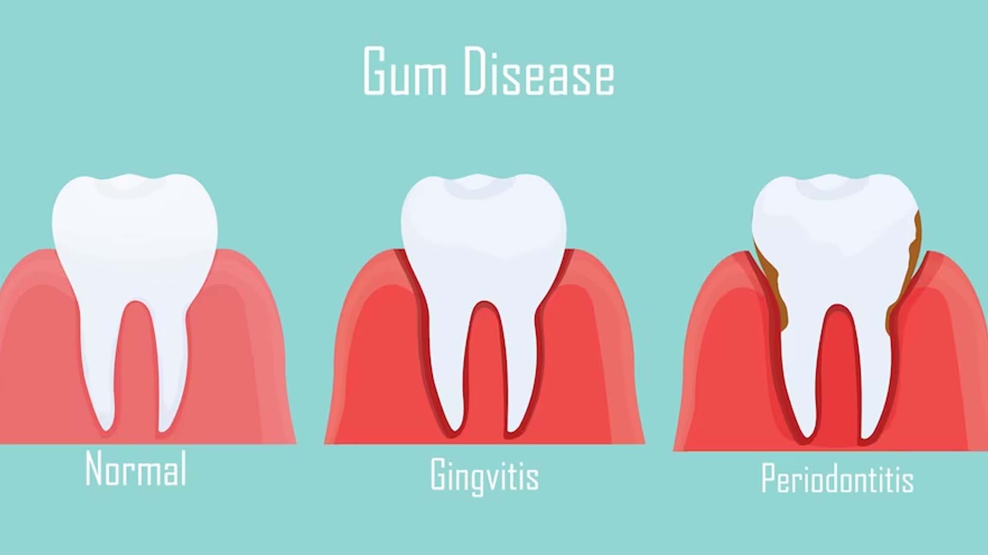 Gum Disease