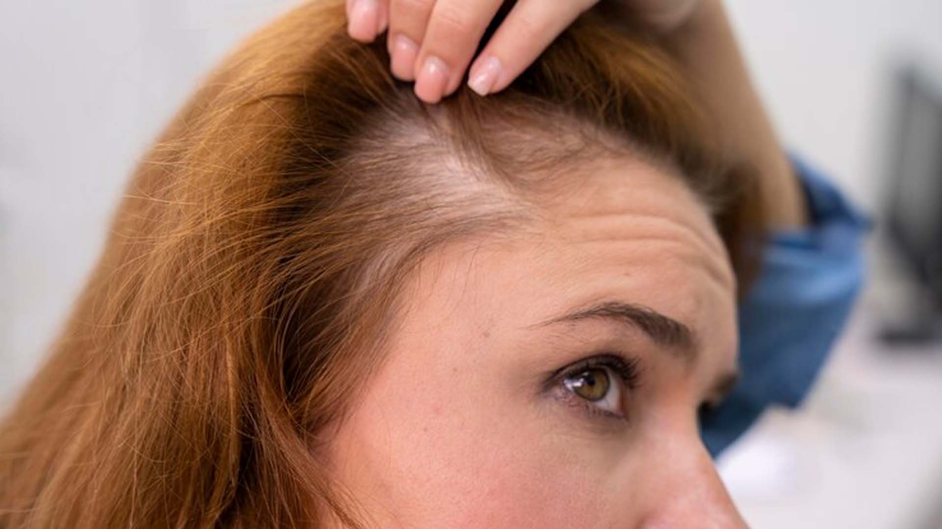 Hair Loss