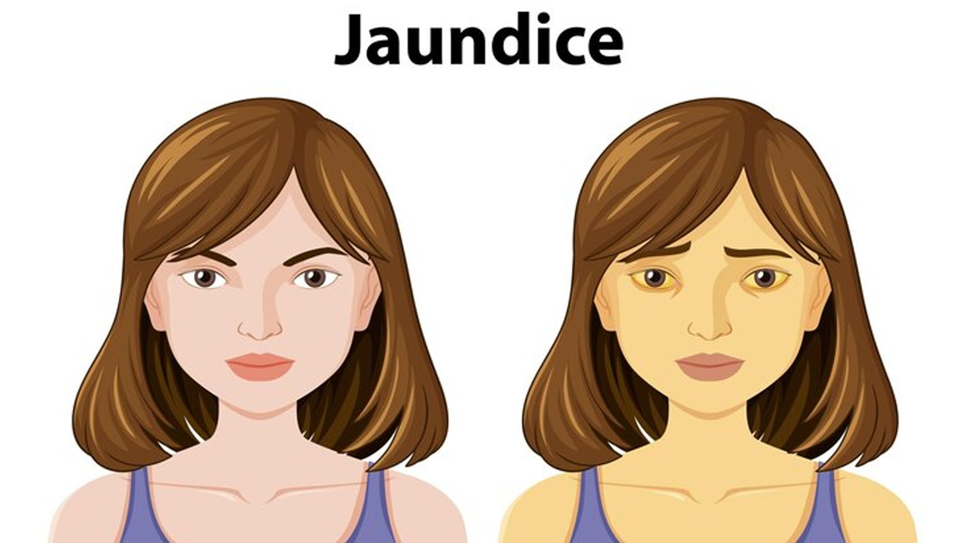 What are the Home Remedies to treat Jaundice?