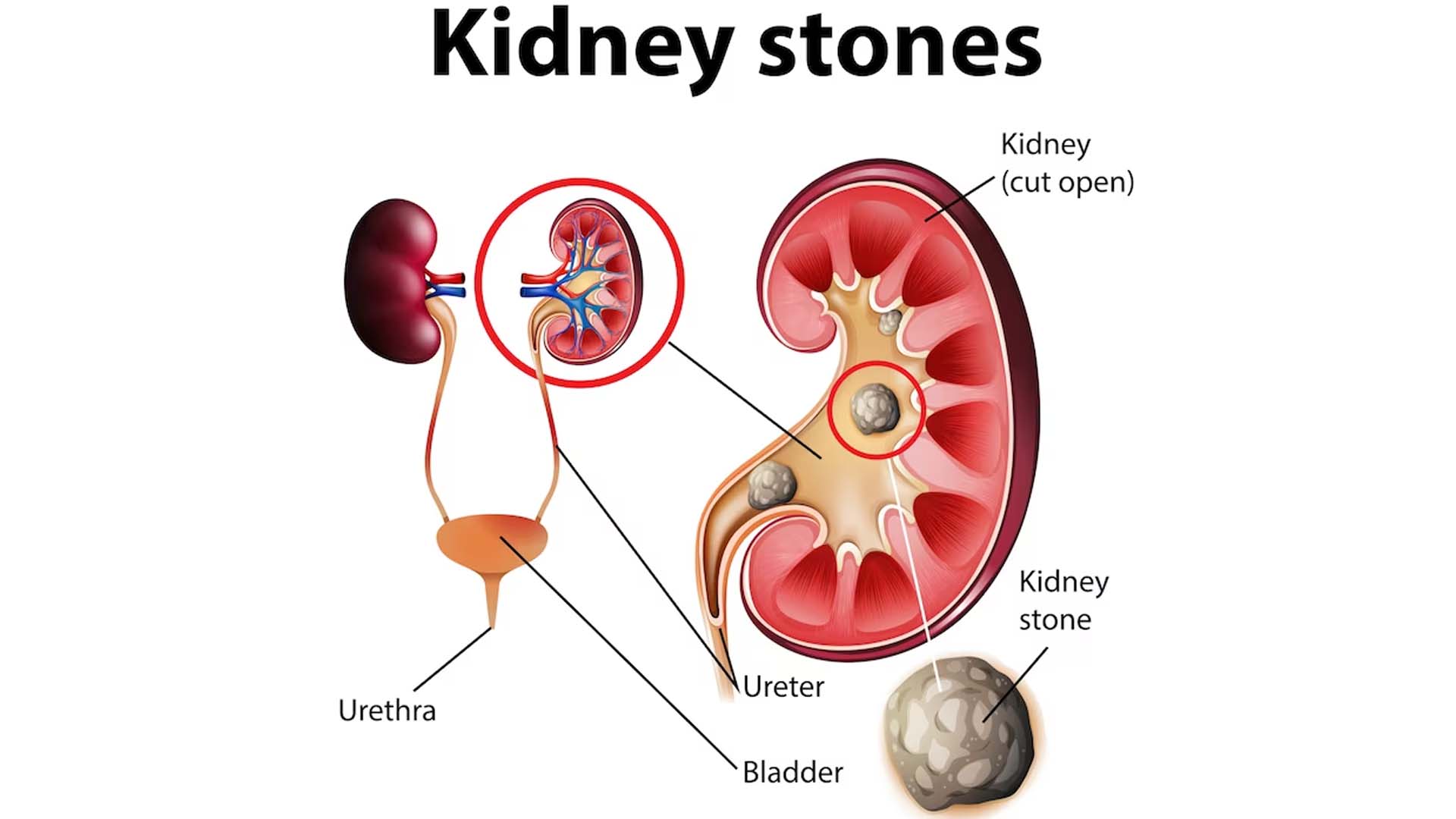 Kidney Stones