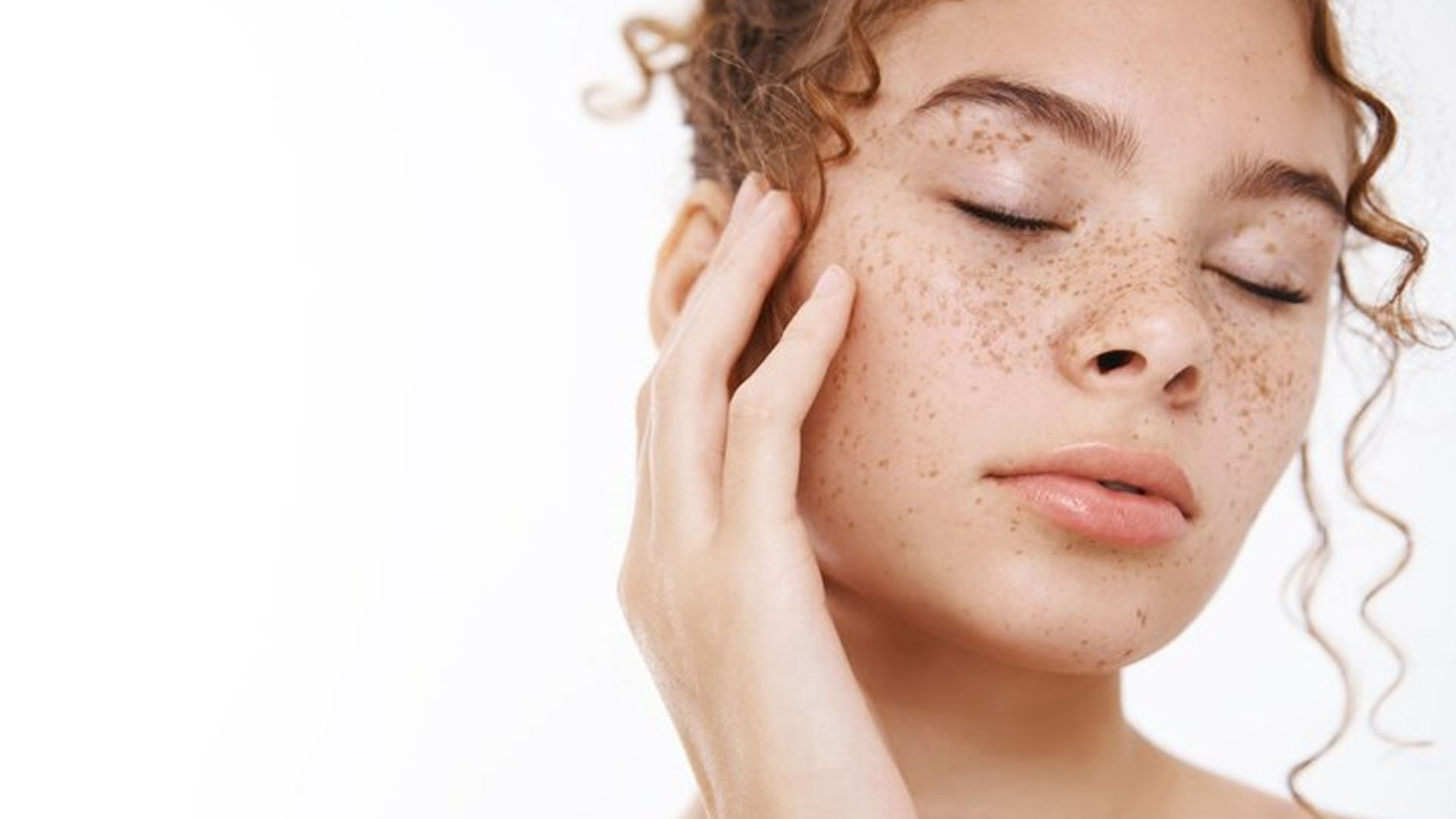 What are the Home Remedies for Melasma?