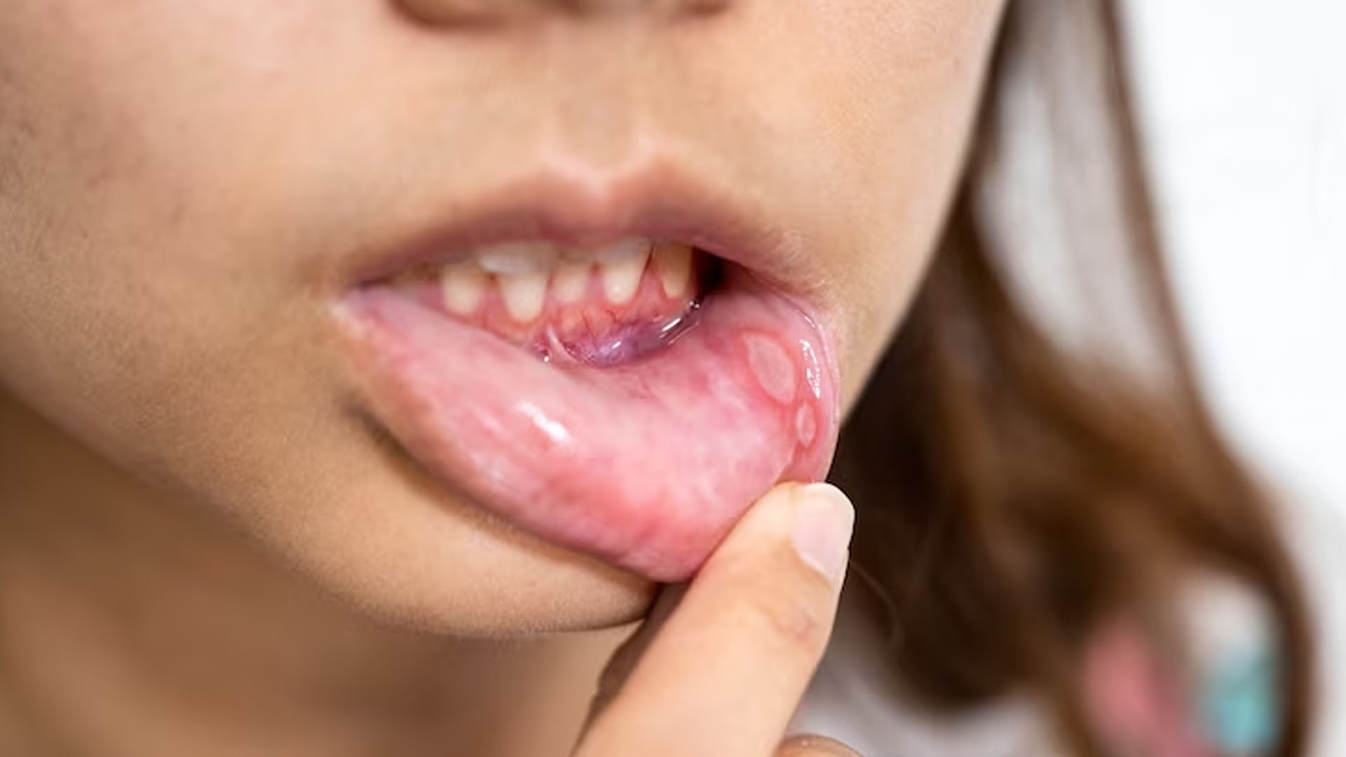 What are the Home Remedies for Mouth Blisters?