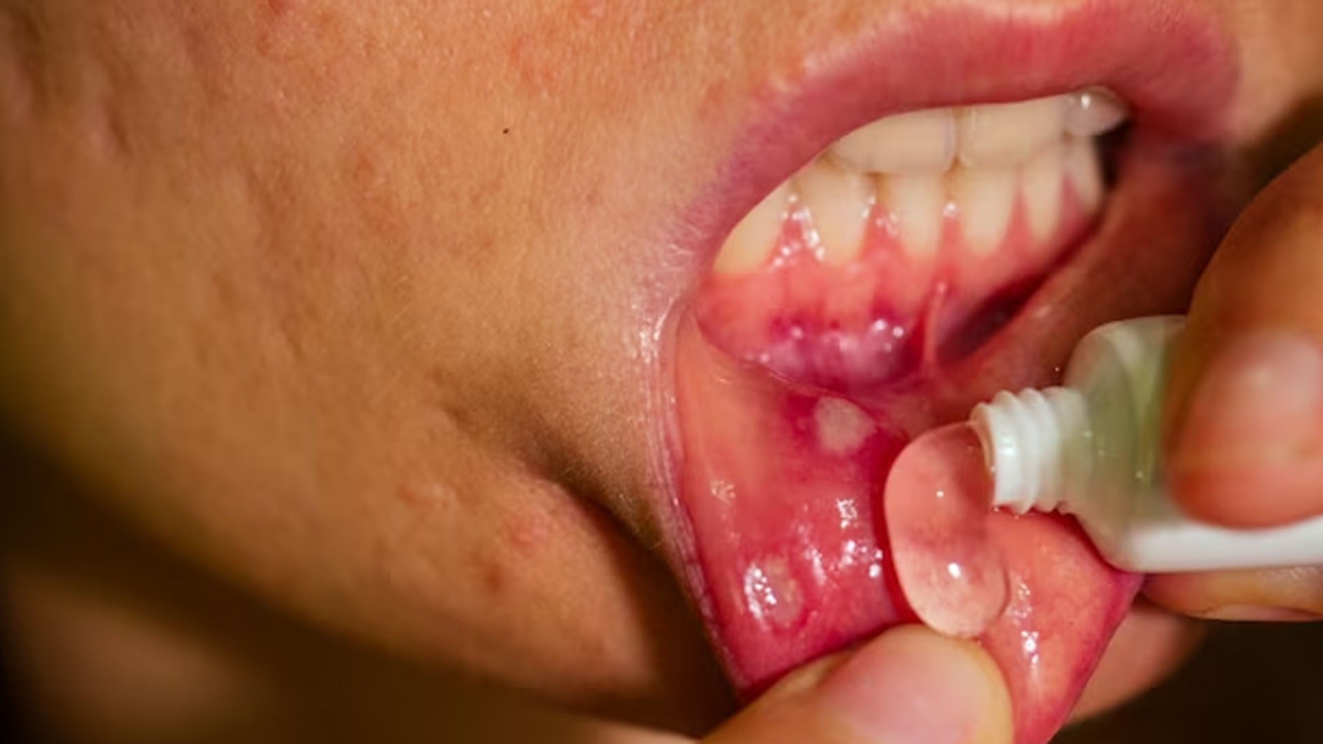 What are the Home Remedies for Mouth Ulcers?