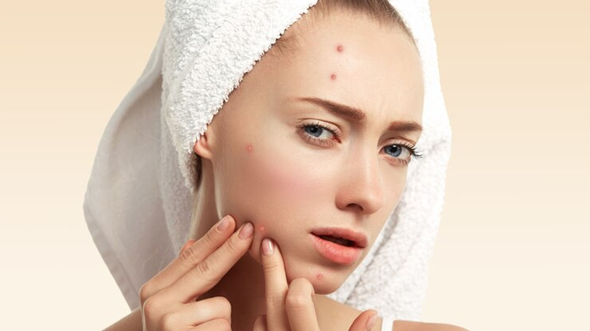 What are the Home Remedies for Pimples?