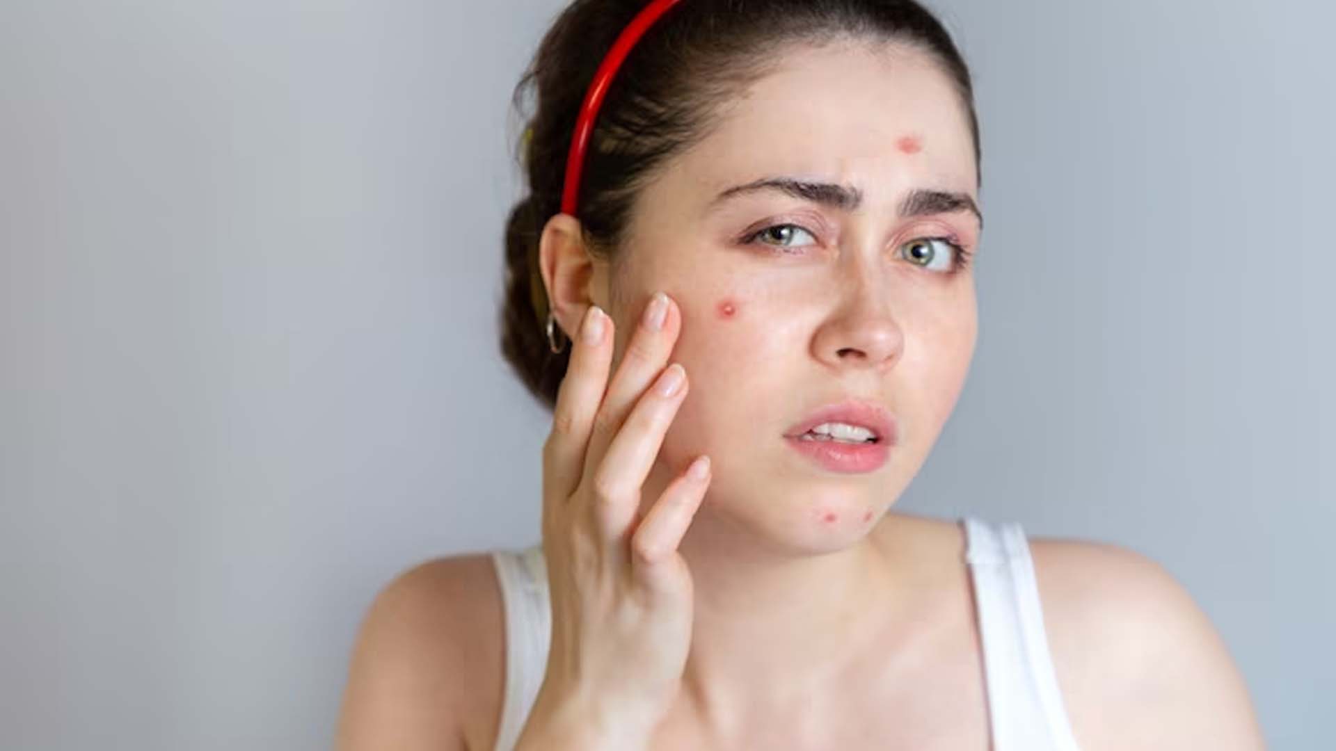 Pimples
