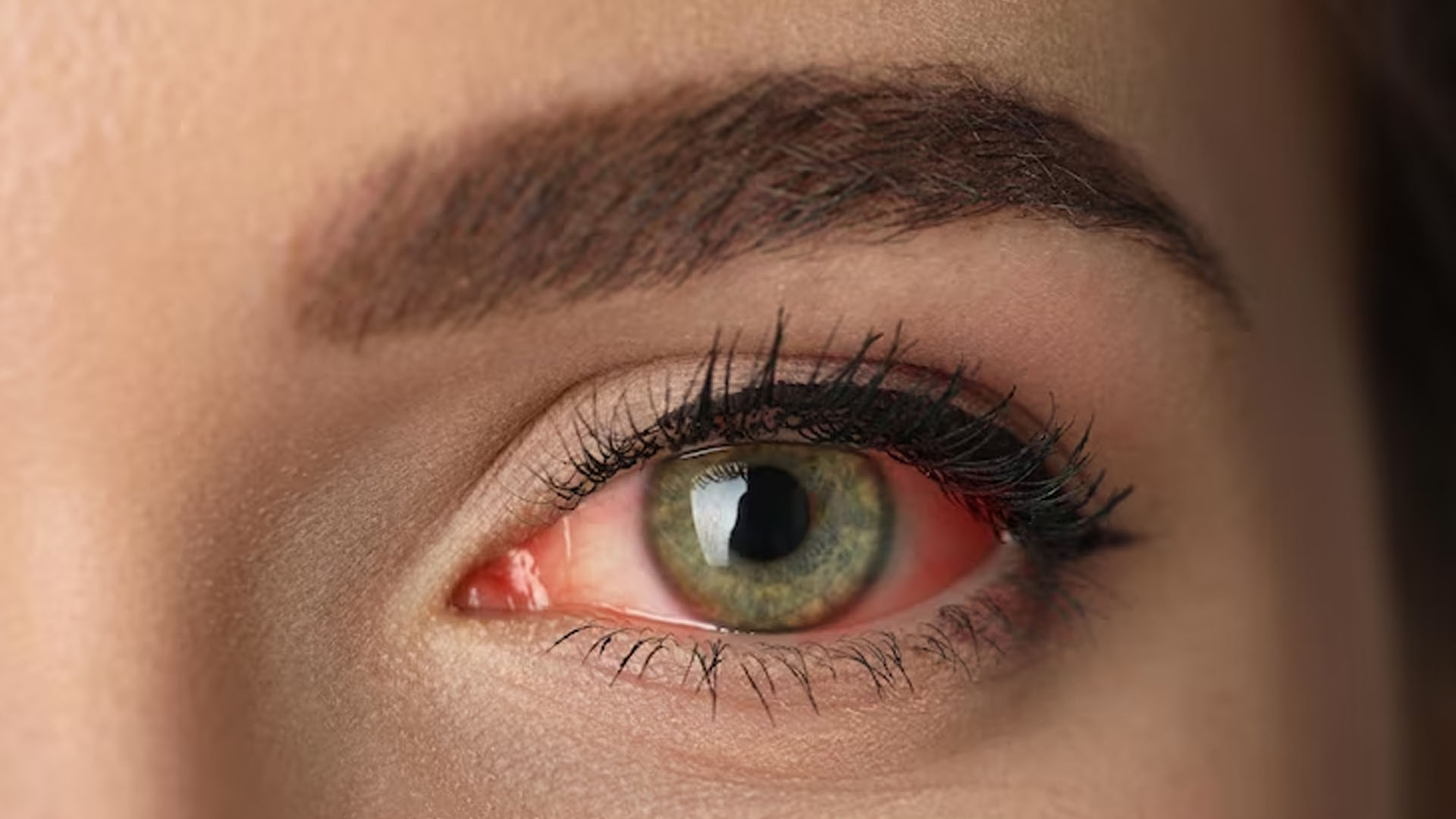 What are the Home Remedies to treat Red Eyes?