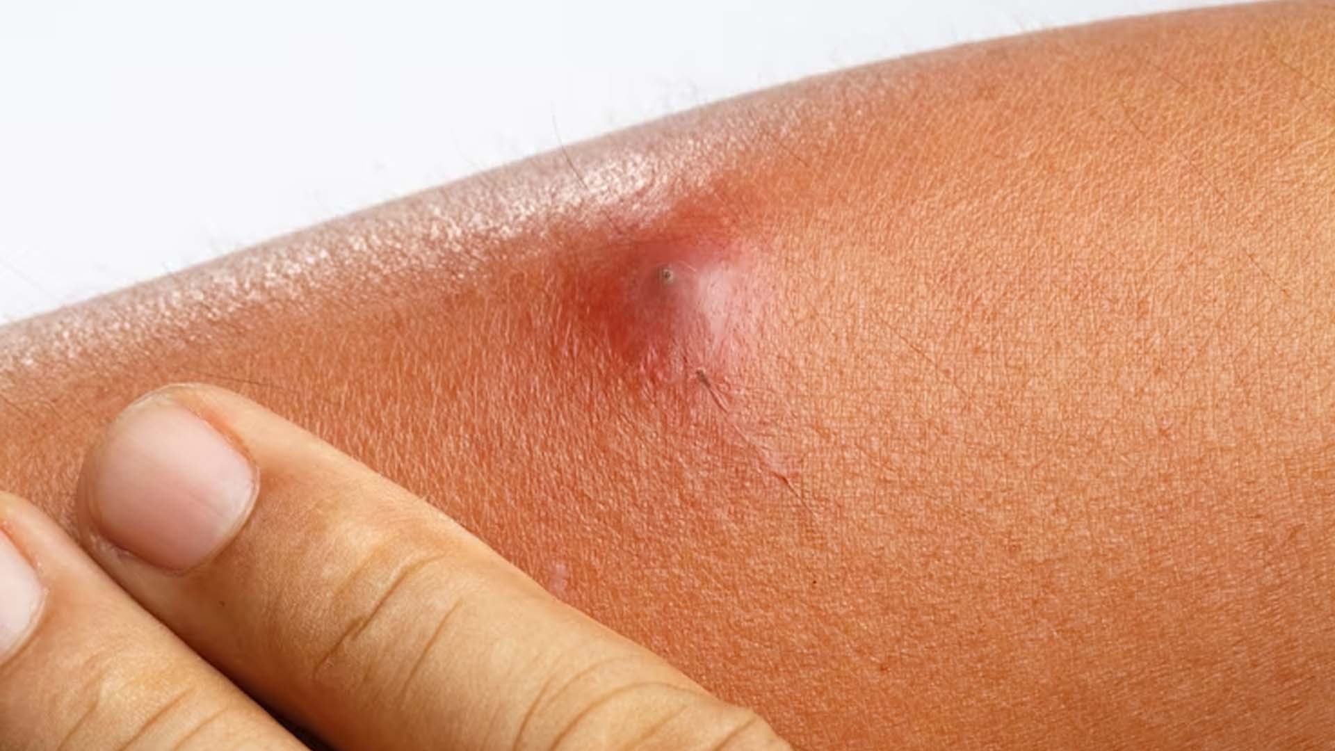 Skin Boils