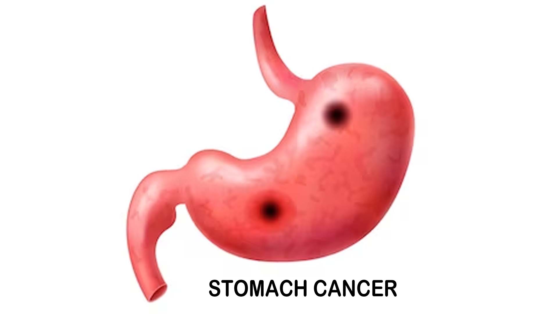Stomach cancer