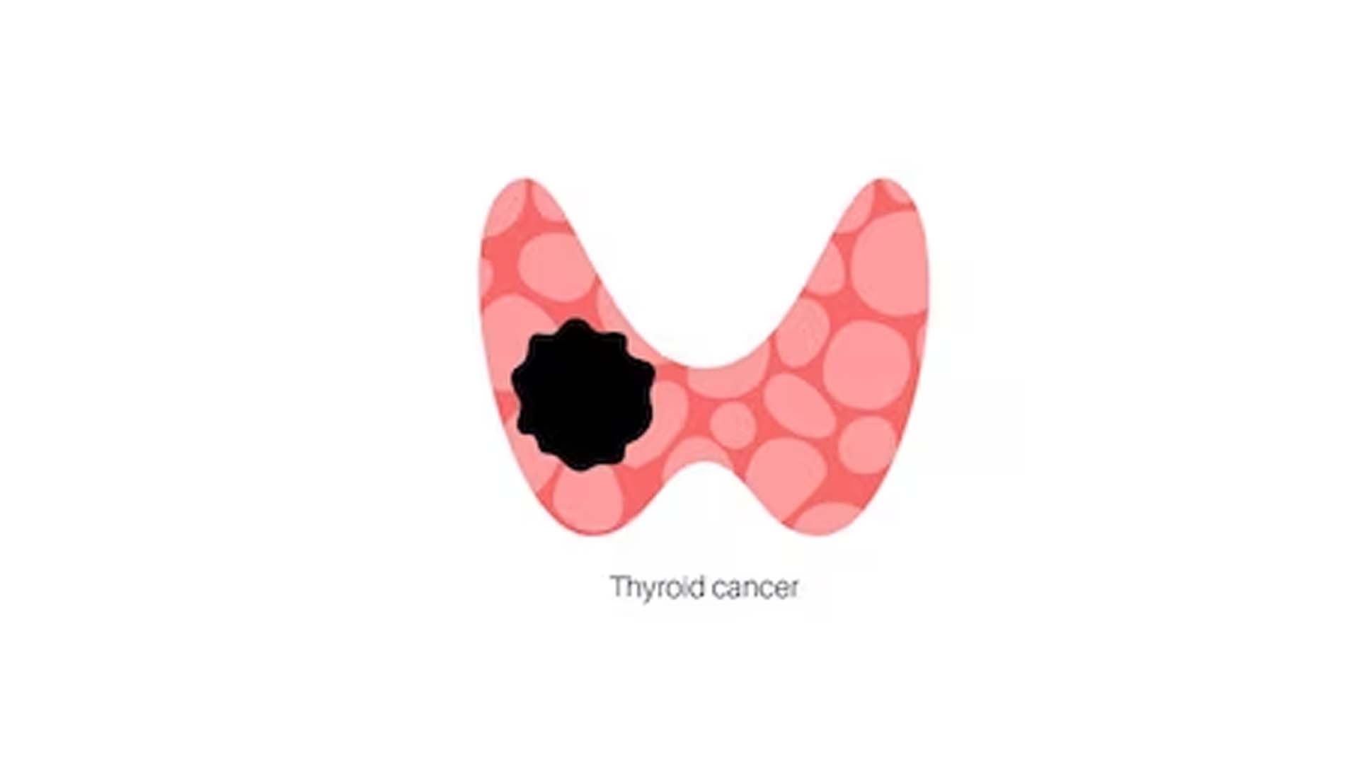 Thyroid Cancer illustration