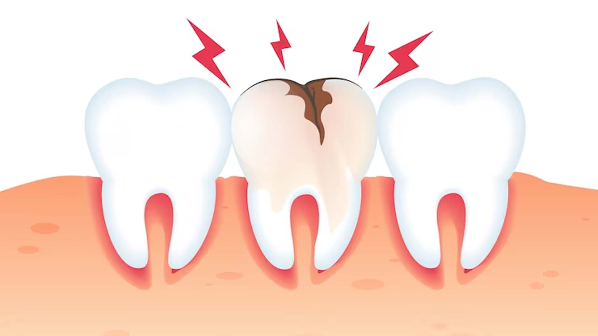 Tooth Cavity