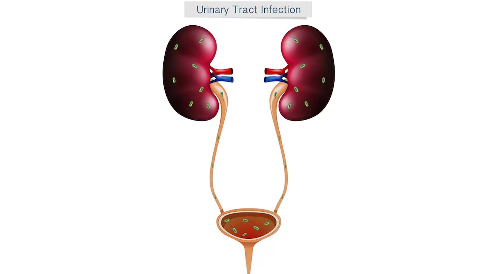 urinary tract infection (UTI)