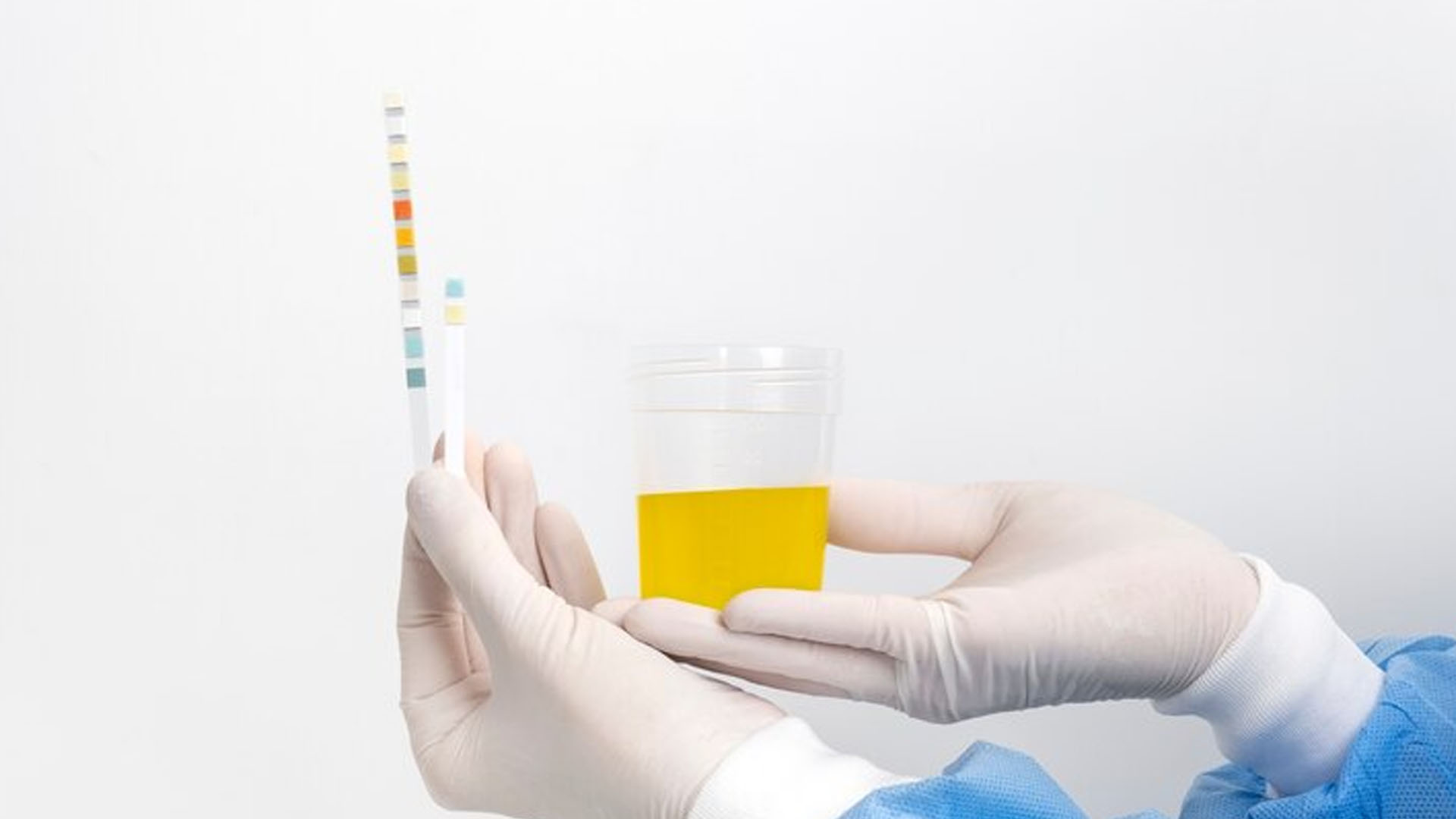 What are the Home Remedies to maintain Uric Acid Levels?